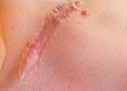 Hypertrophe Narbe
